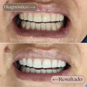 Clareamento dental com resultado mais claro e uniforme