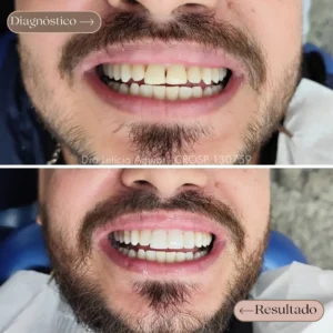 Facetas em resina em homem, antes e depois do sorriso mais alinhado e mais branco