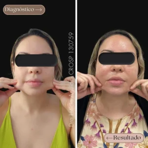Bioestimulador de colágeno no rosto, antes e depois.