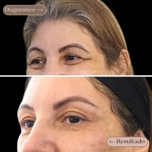 flacidez palpebral - Dra. Leticia Aguiar - Harmonização e Odontologia - Santo Andre - Sao Paulo - Sao Caetano