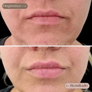 Preenchimento labial com resultado natural