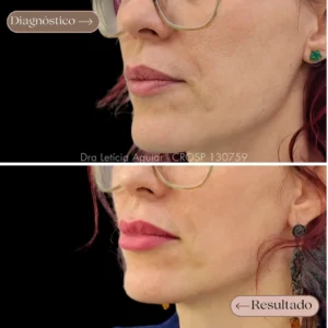 Preenchimento labial com labios volumosos e naturais.