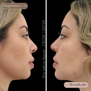 Preenchimento de queixo com harmonização do perfil