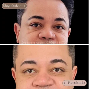 Preenchimento olheiras masculino, antes e depois.
