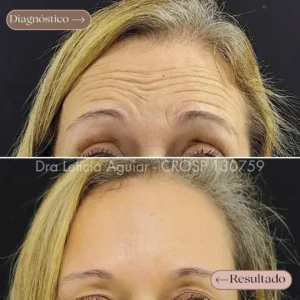 Toxina botulínica facial com suavização de rugas.