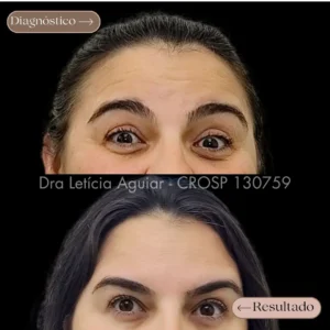 Toxina botulínica facial com efeito fox eyes para levantar o olhar