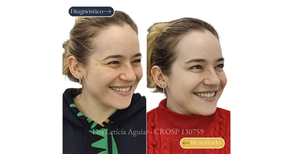 fotos de antes e depois de toxina botulinica/botox com resultados naturais feito pela Dra. Letícia Aguiar