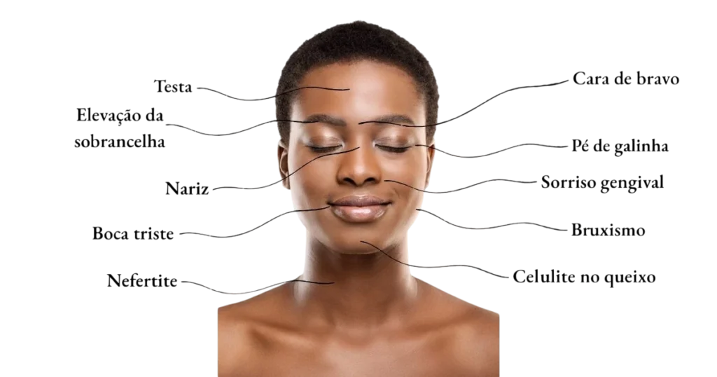imagem com rosto de mulher apontando os locais de aplicação da toxina botulinica/botox feito pela Dra. Letícia Aguiar