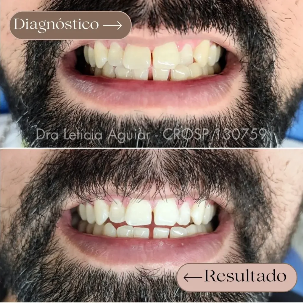 Resultado de tratamento de clareamento dental com melhora da tonalidade dos dentes após o tratamento realizado pela dra Letícia Aguiar nas cidades de Santo André e São Paulo.