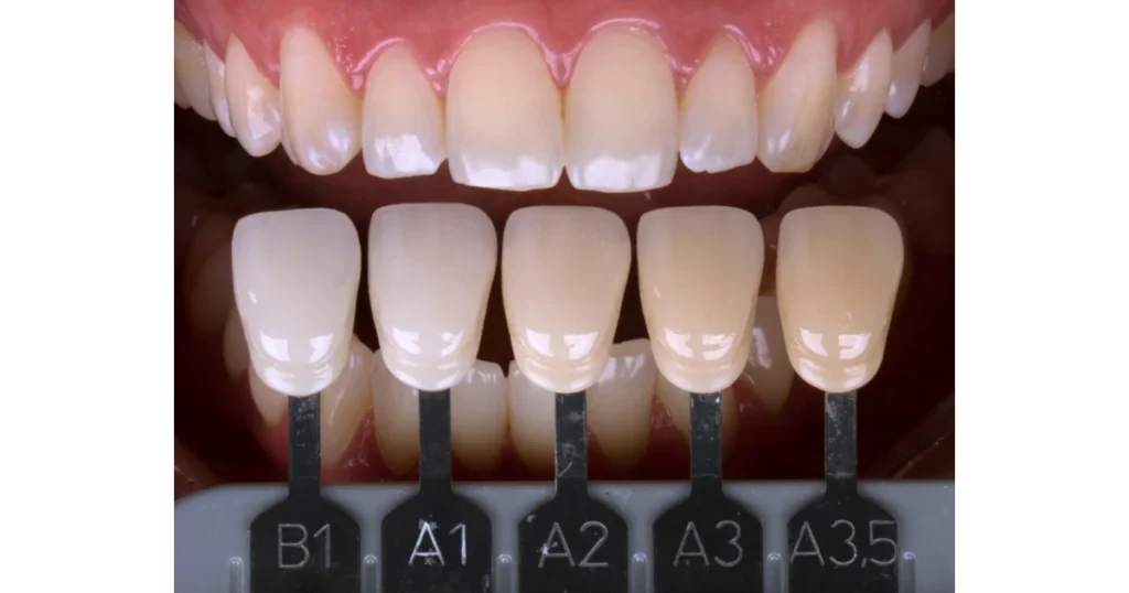 Comparação de tonalidades dentárias através de escala de cor utilizada no planejamento do clareamento dental.