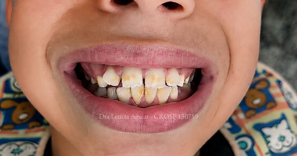 Mancha branca em dente anterior causada por alteração do esmalte observada durante consulta odontológica infantil, antes do tratamento, realizado por Dra. Letícia Aguiar em Santo André e São Paulo
