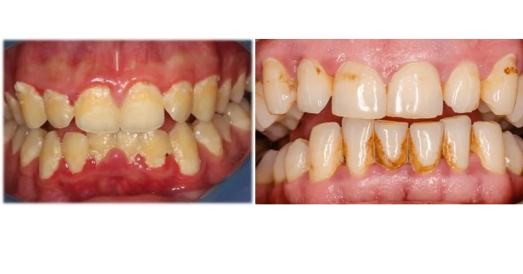 Acúmulo de tártaro nos dentes

O tártaro não pode ser removido apenas com escovação e fio dental, sendo necessária a remoção profissional.