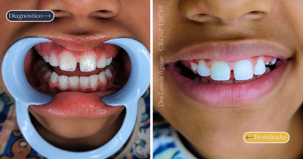 Comparação antes e depois da remoção de mancha dentária com melhora da uniformidade da cor do esmalte, realizado por Dra. Letícia Aguiar em Santo André e São Paulo