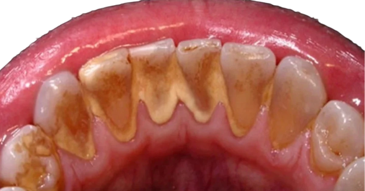 Acúmulo de tártaro nos dentes
