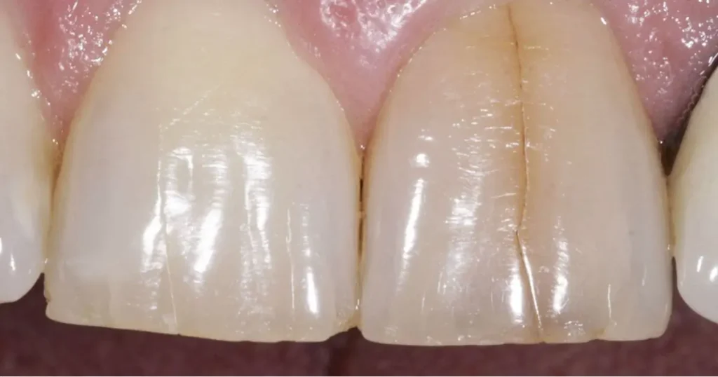 foto de dente trincado