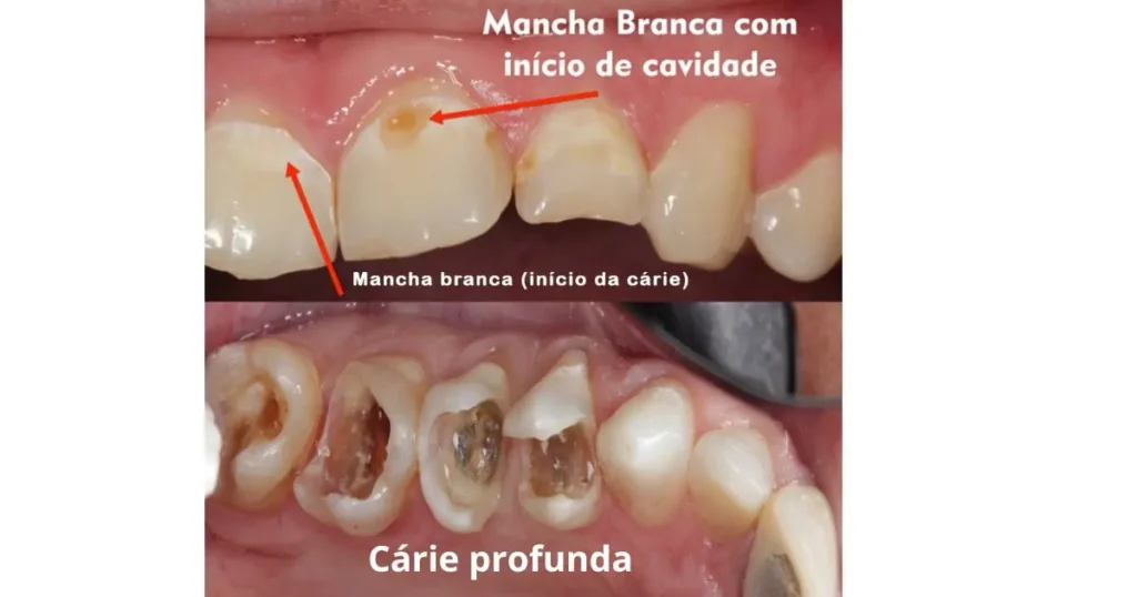 Cárie inicial e necessidade de restauração