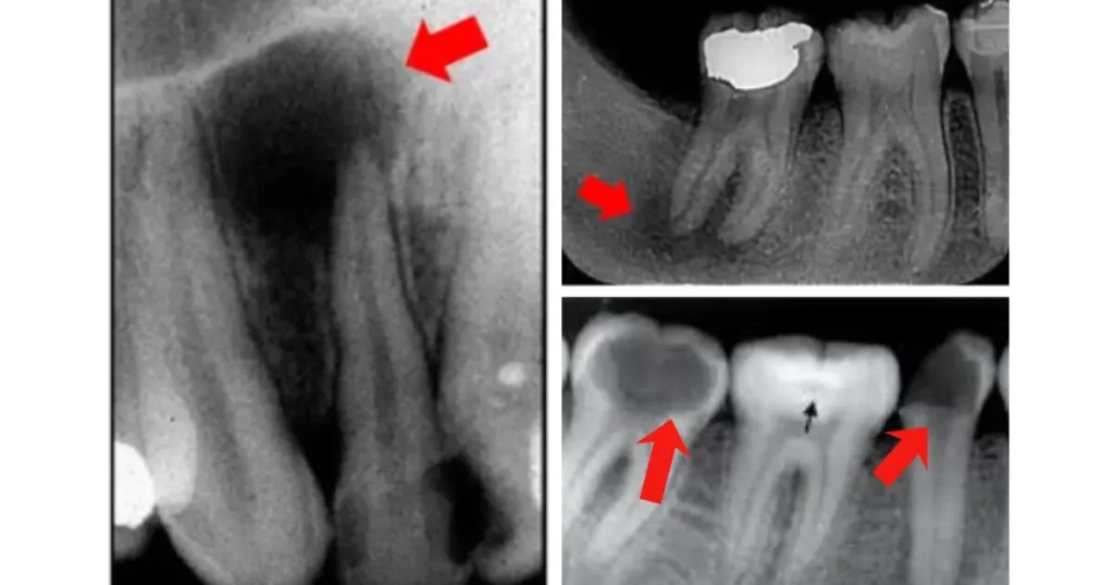 Radiografia mostrando lesão periapical ou comprometimento pulpar com necessidade de tratamento de canal, feito por Dra. Letícia Aguiar