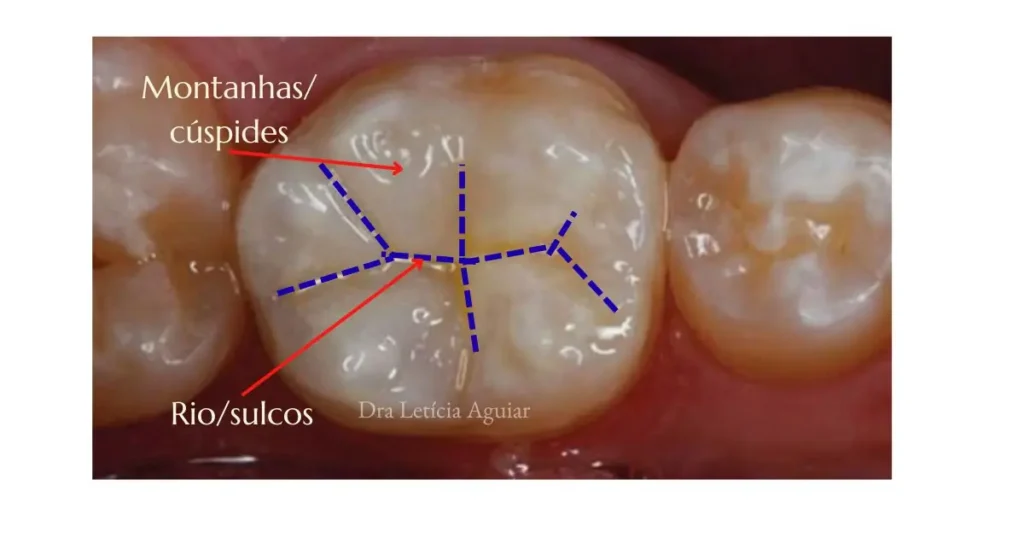 Demonstração de cuspides e sulcos e fóssulas no dente com indicação para selante resinoso