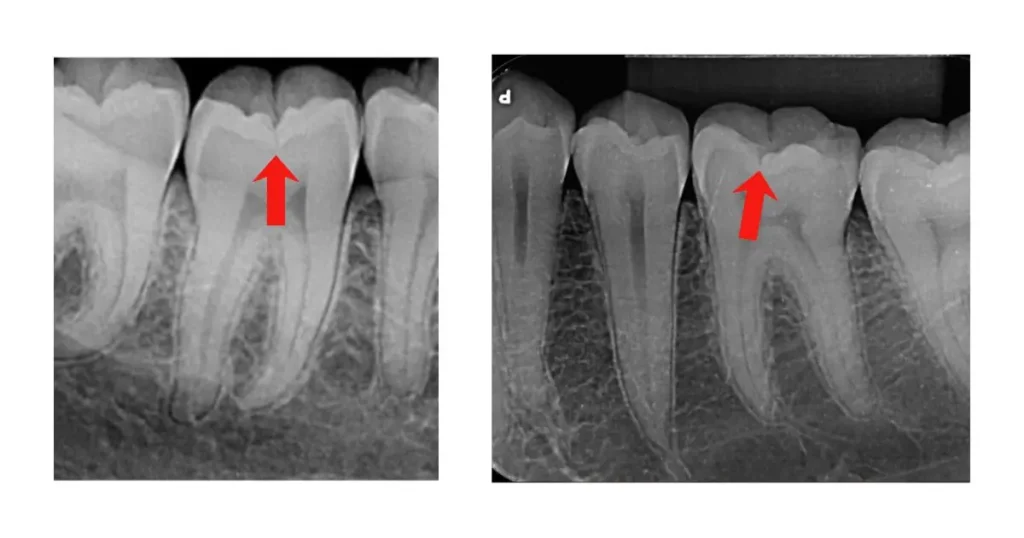Demonstração de sulcos profundos em radiografia periapical do dente com indicação para selante resinoso