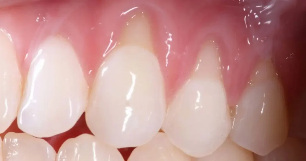 Desgaste dental e retração gengival causando sensibilidade dentária 