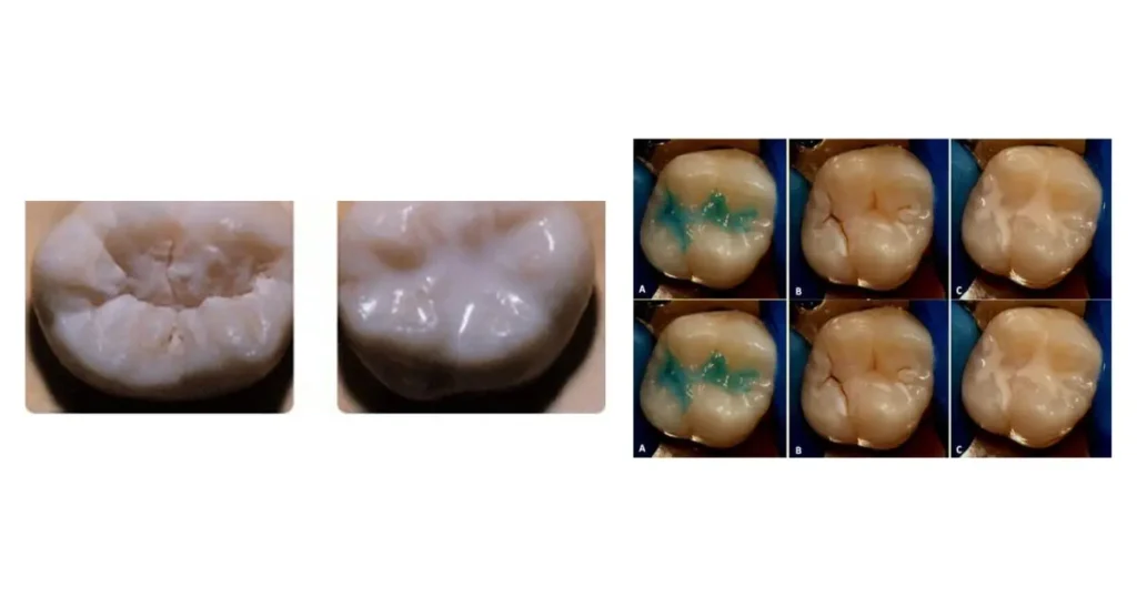 Antes e depois de aplicação de selante resinoso no dente para prevenção de cárie 