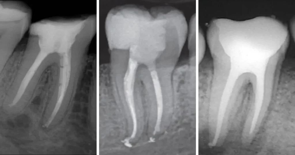 Tratamento de canal/endodontia realizado para preservar o dente pela Dra. Letícia Aguiar