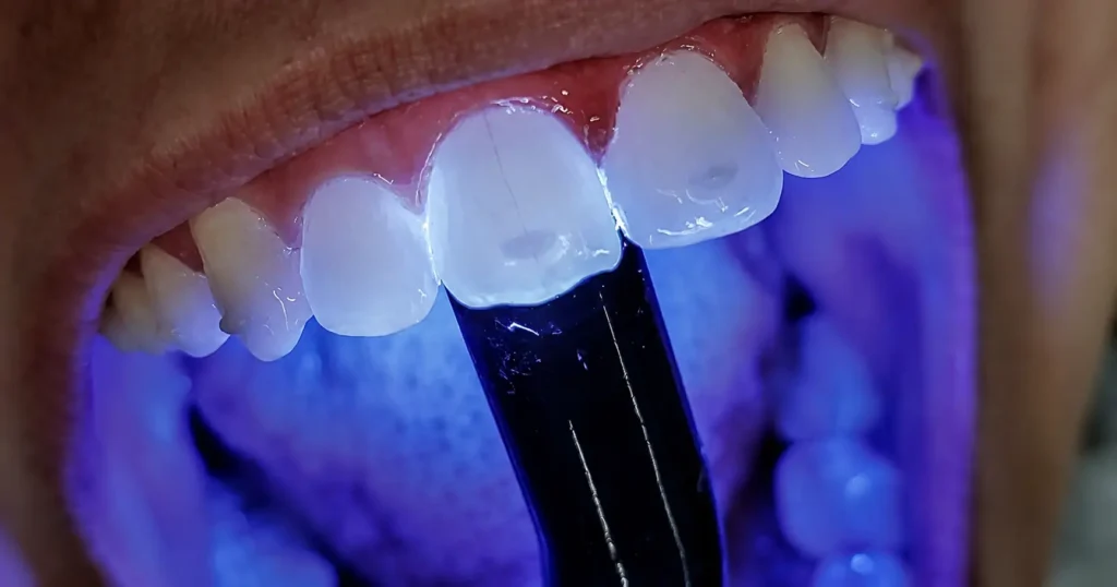 foto de dente trincado iluminado por um fotopolimerador/ luz azul para diagnóstico