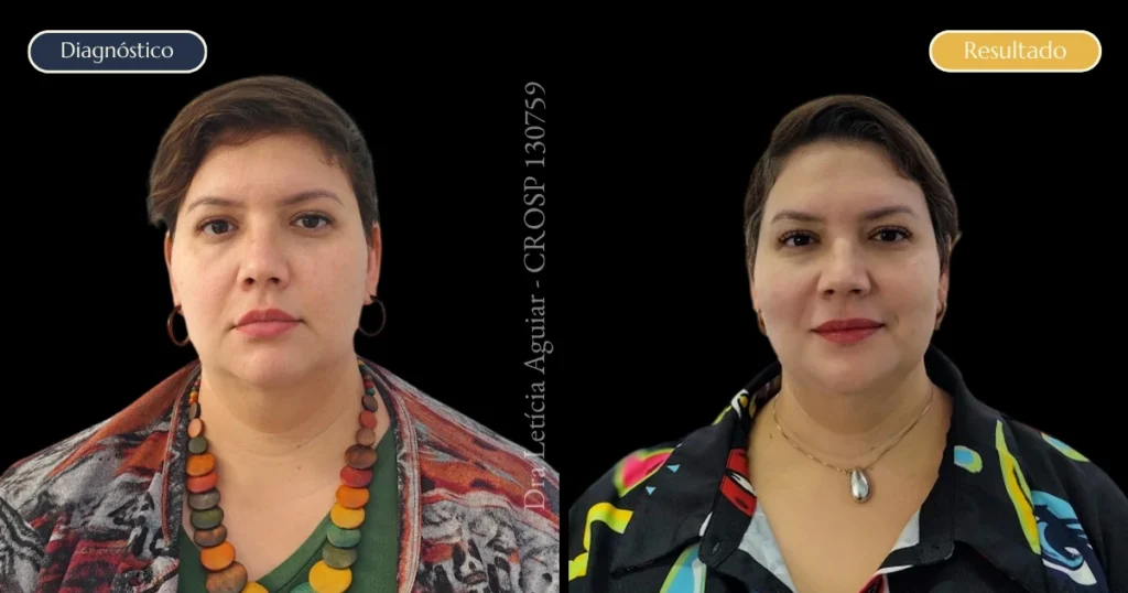 Antes e depois de mulher após tratamento facial, mostrando melhora da firmeza e do contorno do rosto