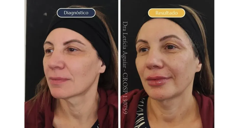 Antes e depois de um caso de preenchimento labial, mostrando como pequenas mudanças nos lábios podem contribuir para o equilíbrio das proporções faciais.