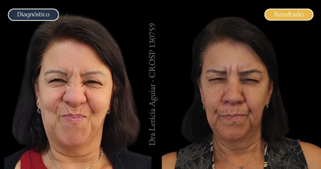 Resultado de toxina botulínica com suavização de rugas durante expressão facial